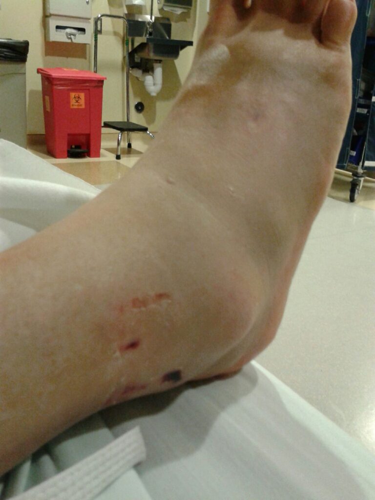 Brutal! My stepmom's foot and ankle